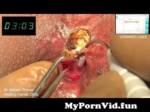 Anal stricture porn