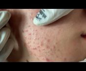 Acne treatment Hương Đà Nẵng