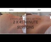 Restore Therapy Scar Training and Scar Clinic