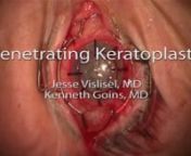 This video was recorded for EyeRounds by Jesse Vislisel, MD and Kemmeth M. Goins, MDnPenetrating keratoplasty (PKP) performed on a patient with severe corneal scarring and nstromal thinning after developing bacterial keratitis in the setting of HSV-related neurotrophic ndisease.Manual trephination was performed as we were unable to achieve suction with the nvacuum trephine due to the irregular corneal surface.