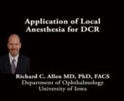 This is Richard Allen at the University of Iowa.This video demonstrates the application of local anesthetic for a patient who is undergoing an awake external DCR.Palpation of the lacrimal sac results in reflux of purulent material from the upper and lower puncta.A marking for the incision is then made along the side of the nose extending from the medial canthal tendon inferiorly toward the ala of the nose.The injection is then placed by entering the caruncle and palpation the medial orbi