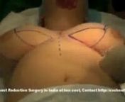 Breast Reduction surgery in India from breastreduction