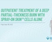 RECELL® System - Case Study XXX: Outpatient Treatment of a Deep Partial-Thickness Burn from à¦•à¦¾à¦•à¦¿à¦®à¦¾à¦°xxx