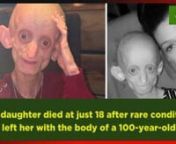 Ashanti Smith had been living with the ultra rare premature ageing condition Hutchinson-Gilford Progeria Syndrome, which saw her age eight years for every year of her life.nnhttps://img.particlenews.com/image.php?url=2UKgRi_0b3aU0yr00nAshanti Smith had been living with the ultra rare premature aging condition Hutchinson-Gilford Progeria Syndrome - when she turned 18 she was able to enjoy a cocktail Credit: Kennedy NewsnTragically, the 18-year-old died on July 17, telling her heartbroken mother t