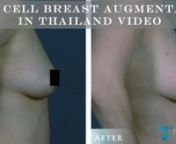 Are You Looking For a Safe &amp; Natural Alternative to Breast Implants?nFeeling Overly Self-Conscious or Embarrassed About Your Cup Size?nnThe Patented Stem Cell Enhanced Natural Breast Augmentation in Thailand uses your own stem cell rich tummy fat, to enlarge their breast without the use of unnatural breast implants. These stem cells are from your own body and not from the often controversial embryonic stem cells. The CAL results is enlarged breasts that are natural in appearance and touch wi