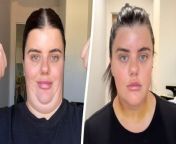 A mum spent £2k on surgery to remove her double chin - transforming it from &#92;