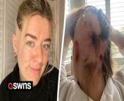 A woman who started getting bald patches aged 13 is finally accepting her alopecia – and is taking “back control”.&#60;br/&#62;&#60;br/&#62;Nicole Thomas, 27, was just a teenager when her hairdresser noticed a bald patch at the nape of her neck.&#60;br/&#62;&#60;br/&#62;She went to the GP and tried several different treatments before she was referred to a dermatologist who diagnosed Nicole with alopecia areata – an autoimmune disease which causes patchy hair loss. &#60;br/&#62;&#60;br/&#62;Nicole lost 70 per cent of her hair and wore wigs for three years before she saw a steady regrowth aged 17.&#60;br/&#62;&#60;br/&#62;For the last eight years, Nicole has had “stable” hair growth and loss but 18 months ago she started to notice her alopecia had returned with a “vengeance”.&#60;br/&#62;&#60;br/&#62;Nicole has lost around 60% of her hair – at the back, hairline and on the crown of her head – but is determined to not be “crippled” by it this time round.&#60;br/&#62;&#60;br/&#62;She says the news the NHS has approved the drug Ritlecitinib for people with alopecia is a “big milestone”.&#60;br/&#62;&#60;br/&#62;Nicole, who works in communications, from Cardiff, said: “At aged 13 it was such a devastating time.&#60;br/&#62;&#60;br/&#62;“I was so crippled by the condition.&#60;br/&#62;&#60;br/&#62;“I felt quite alone.&#60;br/&#62;&#60;br/&#62;“It controlled me.&#60;br/&#62;&#60;br/&#62;“Now I’m taking back control.”&#60;br/&#62;&#60;br/&#62;Nicole tried all sorts of treatments as a teenager for her hair loss such as ointments and steroid creams.&#60;br/&#62;&#60;br/&#62;She said: “I was quite a shy teenager. I didn’t handle it very well.&#60;br/&#62;&#60;br/&#62;“I was always wearing a wig – it was hideous and hot.&#60;br/&#62;&#60;br/&#62;“There is a loss of control – not being able to do anything about the situation.&#60;br/&#62;&#60;br/&#62;“It’s really traumatic.&#60;br/&#62;&#60;br/&#62;“My sister used to joke I looked like I belonged on shutter island.”&#60;br/&#62;&#60;br/&#62;Nicole had steroid injections directly into her scalp which helped spark hair growth and she felt she could stop wearing her wig aged 17.&#60;br/&#62;&#60;br/&#62;She said: “Since then I had pretty stale hair growth and hair loss.&#60;br/&#62;&#60;br/&#62;“Up until 18 months ago. I was told it could come back with a vengeance.”&#60;br/&#62;&#60;br/&#62;In late 2022, Nicole started to notice she was balding at the back of her head but instead of hiding it like before she decided to start sharing her journey on TikTok.&#60;br/&#62;&#60;br/&#62;She tried some oral steroids to stop the hair loss but it didn’t work.&#60;br/&#62;&#60;br/&#62;She said: “I thought I could make a positive out of it.&#60;br/&#62;&#60;br/&#62;“It just so happens my hair is falling out.&#60;br/&#62;&#60;br/&#62;“It doesn’t make you a weak person. Or less than or less attractive.”&#60;br/&#62;&#60;br/&#62;Nicole says the news the NHS has approved the drug Ritlecitinib for people with alopecia is a “big milestone”.&#60;br/&#62;&#60;br/&#62;She says it was something she looked into previously but couldn’t afford the £3k monthly bill.&#60;br/&#62;&#60;br/&#62;Now she’s not sure if she’ll end up taking the drug but thinks it’s great it’s an option.&#60;br/&#62;&#60;br/&#62;Nicole said: “It’s a big milestone for anyone who suffers with alopecia.&#60;br/&#62;&#60;br/&#62;“Alopecia is not life threatening but it doesn’t mean it doesn’t cause harmful health issues – such as mental health.”&#60;br/&#62;&#60;br/&#62;Nicole feels more confident about her own appearance – and is not currently wearing a wig – but does want to “normalise” down days.&#60;br/&#62;&#60;br/&#62;She said: “We’re all told we should love ourselves but that not the case all the time.&#92;