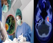 Mesenchymal Tumor: जोधपुर से एक ऐसा मामला सामने आया है, जहां मरीज खरबूजे के आकार का ब्रेन ट्यूमर लेकर जी रहा था। हैरानी वाली बात यह है कि यह ट्यूमर 15 साल पुराना था। &#60;br/&#62; &#60;br/&#62;Mesenchymal Tumor: A case has come to light from Jodhpur, where the patient was living with a melon-sized brain tumor. The surprising thing is that this tumor was 15 years old. &#60;br/&#62; &#60;br/&#62;#MesenchymalTumor #Tumor &#60;br/&#62;~HT.178~PR.115~ED.278~
