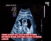 Twins almost kill each other in their mother's womb, doctors forced to induce labour from poy forced